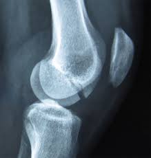 Hoffa Fracture- Trauma